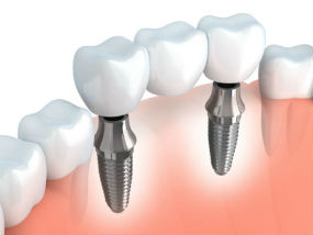Implants provided at Quincy Dental Center, Dr. Pritts, DMD, Quincy, IL Dentist