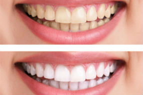 Teeth Whitening available at Quincy Dental Center, Dr. Pritts, DMD, Quincy, IL Dentist