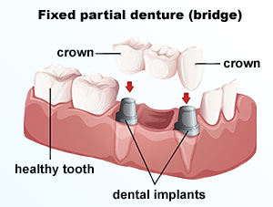 Implants provided at Quincy Dental Center, Dr. Pritts, DMD, Quincy, IL Dentist